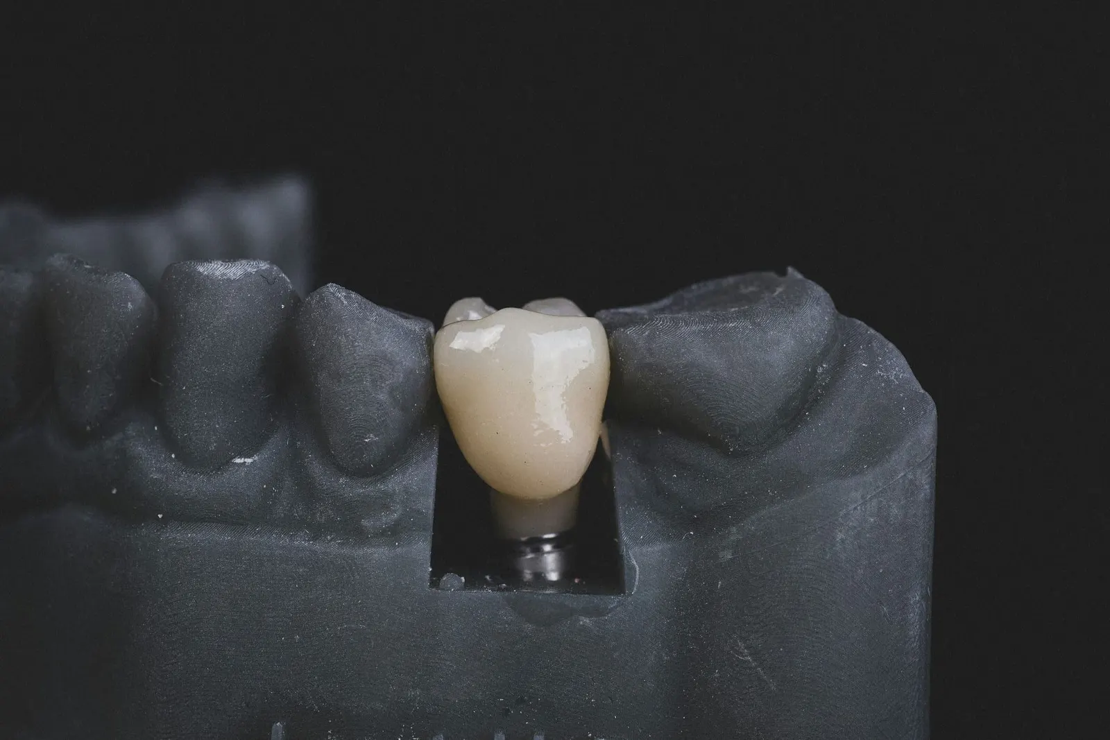 Coupe d'un implant dentaire en titane — fiche conseil implantologie Cabinet Dr Allanche