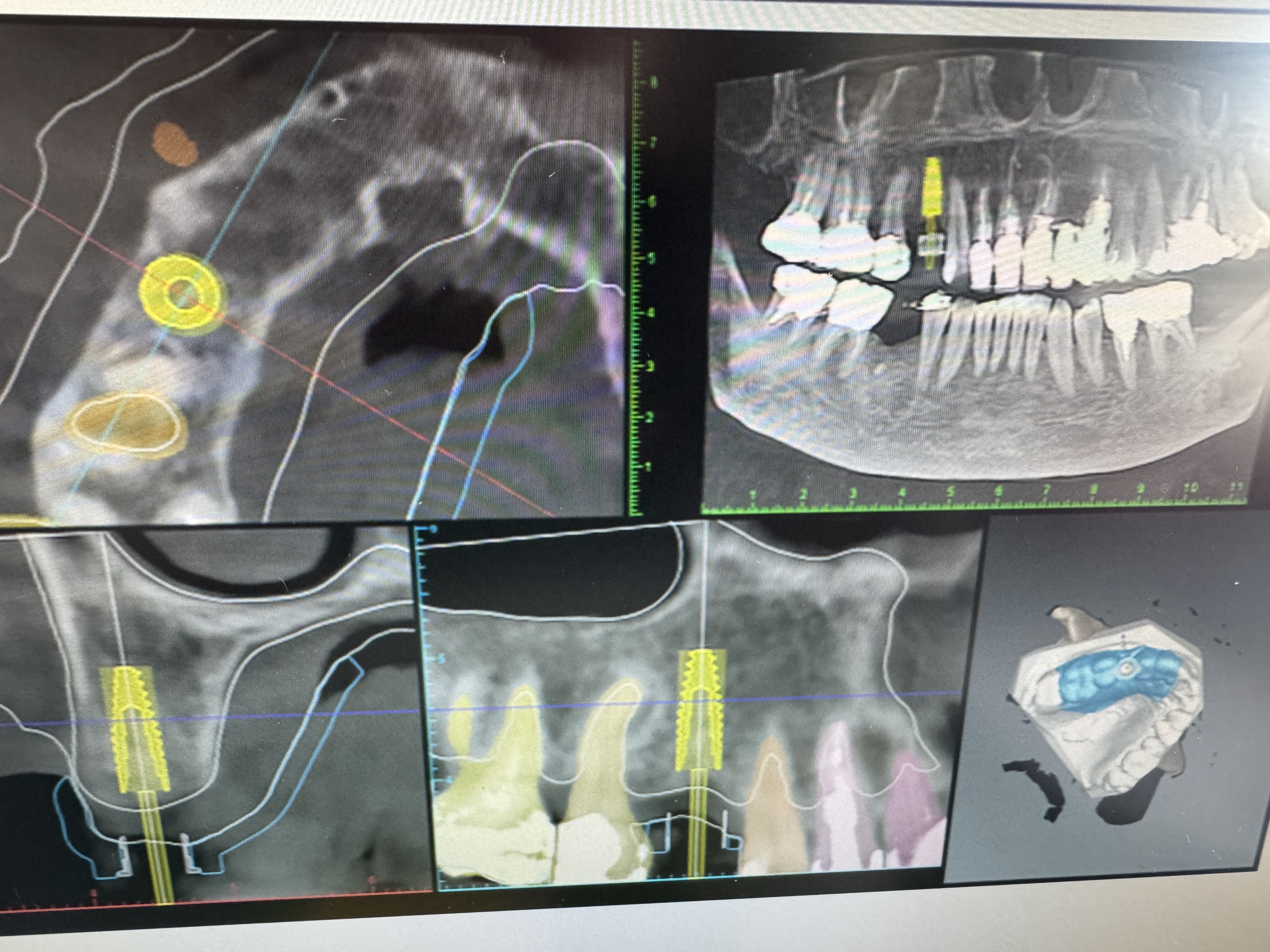 Interface de planification implantaire sur scanner 3D — Cabinet Dr Allanche