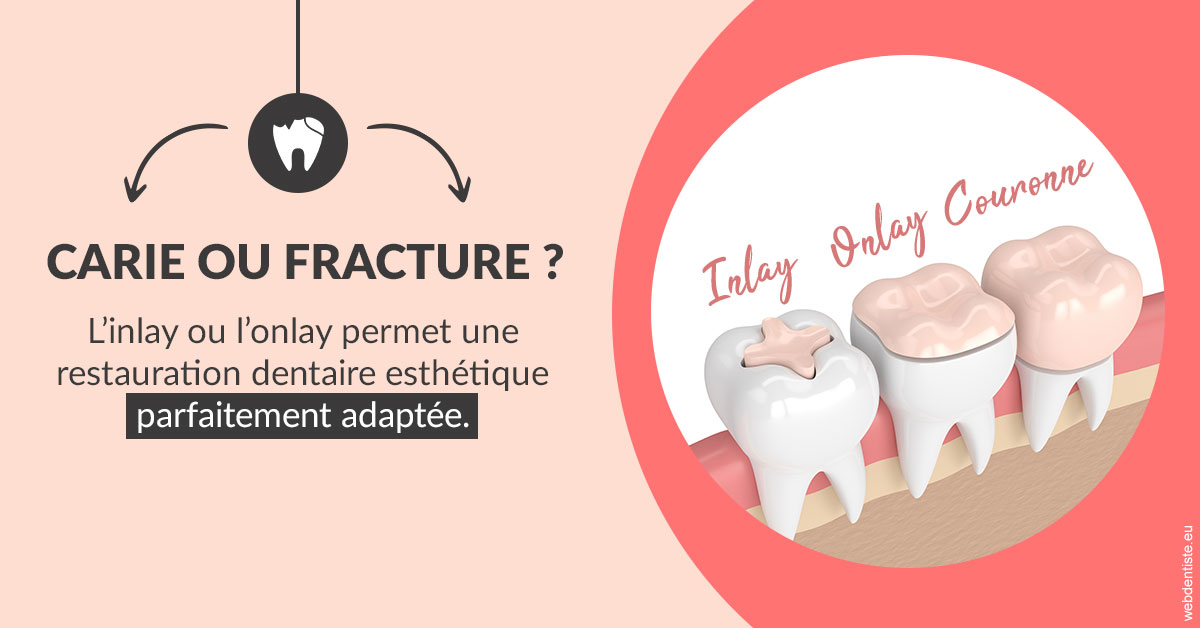 https://cabinetdentaireimplantaire.com/T2 2023 - Carie ou fracture 2