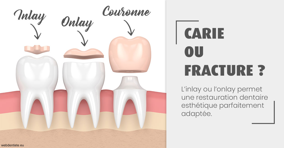 https://cabinetdentaireimplantaire.com/T2 2023 - Carie ou fracture 1