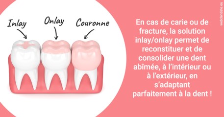 https://cabinetdentaireimplantaire.com/L'INLAY ou l'ONLAY 2