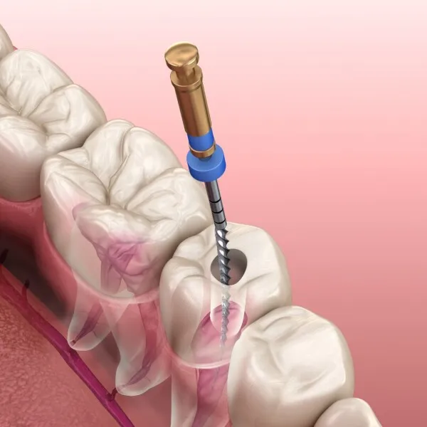 Retraitement endodontique